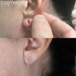 Earlobe-repair-results-150x150.jpg