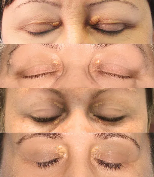 Eyelid-Xanthelasma-removal-clinic.jpg