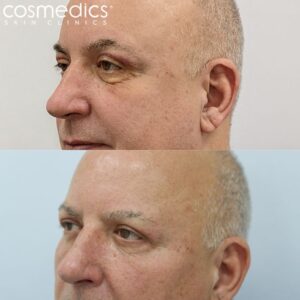 male upper blepharoplasty before after