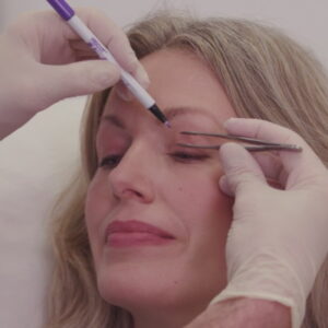 Upper-blepharoplasty-London-300x300.jpg