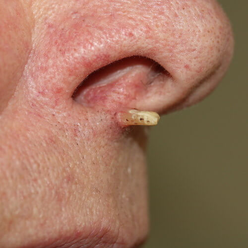 keratotic-horn-for-excision-removal.jpg